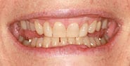Before Image: Case 444 - front
