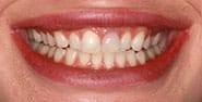 Before Image: Case 445 - front
