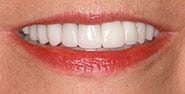 After Image: Case 447 - front