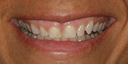 Before Image: Case 45 - front