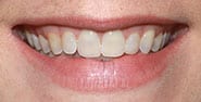 Before Image: Case 450 - front