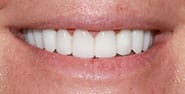 After Image: Case 452 - front