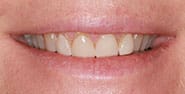 Before Image: Case 452 - front