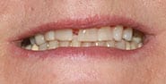 Before Image: Case 454 - front