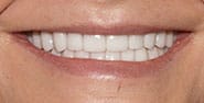 After Image: Case 455 - front