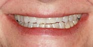 Before Image: Case 455 - front