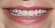 Before Image: Case 458 - front
