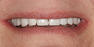 After Image: Case 46 - front