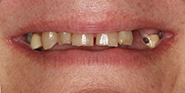Before Image: Case 46 - front