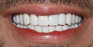 After Image: Case 461 - front