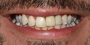 Before Image: Case 461 - front