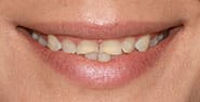 Before Image: Case 464 - front