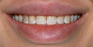 Before Image: Case 466 - front
