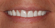 After Image: Case 47 - front