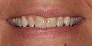 Before Image: Case 47 - front