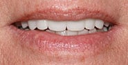After Image: Case 472 - front