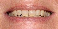 Before Image: Case 472 - front