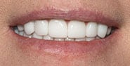 After Image: Case 474 - front