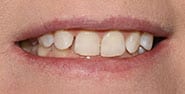 Before Image: Case 474 - front