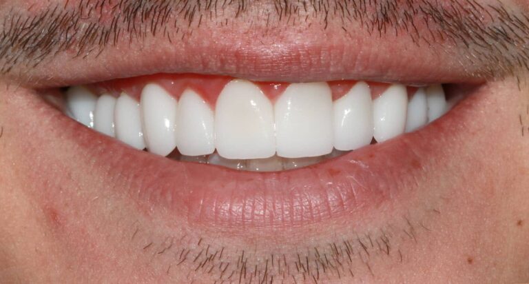 After Image: Case 475 - front