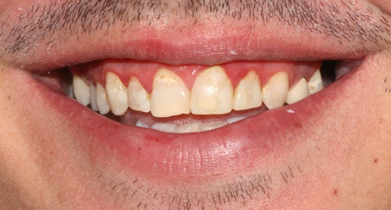 Before Image: Case 475 - front