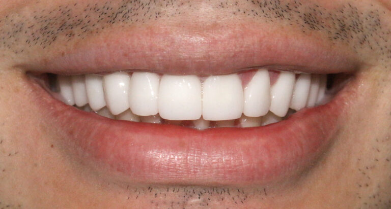 After Image: Case 477 - front