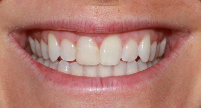 Before Image: Case 478 - front