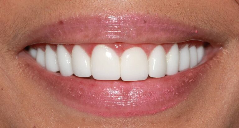 After Image: Case 479 - front