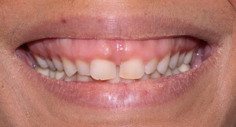 Before Image: Case 479 - front