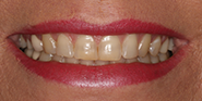 Before Image: Case 48 - front