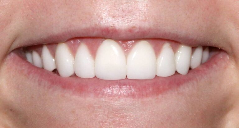 After Image: Case 481 - front
