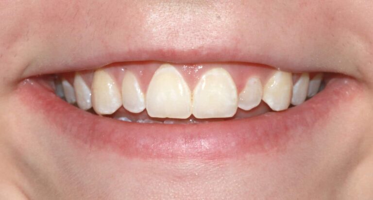 Before Image: Case 481 - front
