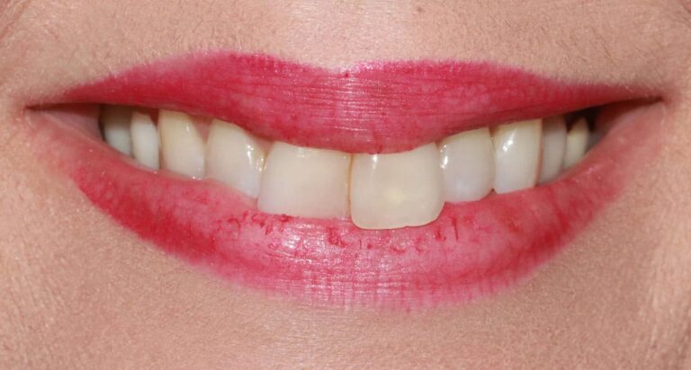 Before Image: Case 482 - front
