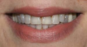 Before Image: Case 483 - front
