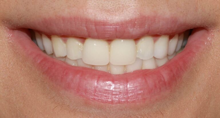 Before Image: Case 484 - front
