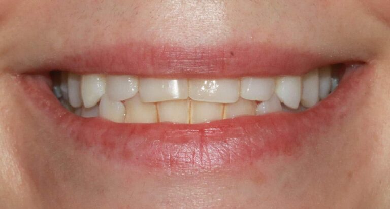 Before Image: Case 485 - front