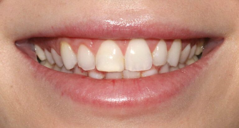 Before Image: Case 486 - front