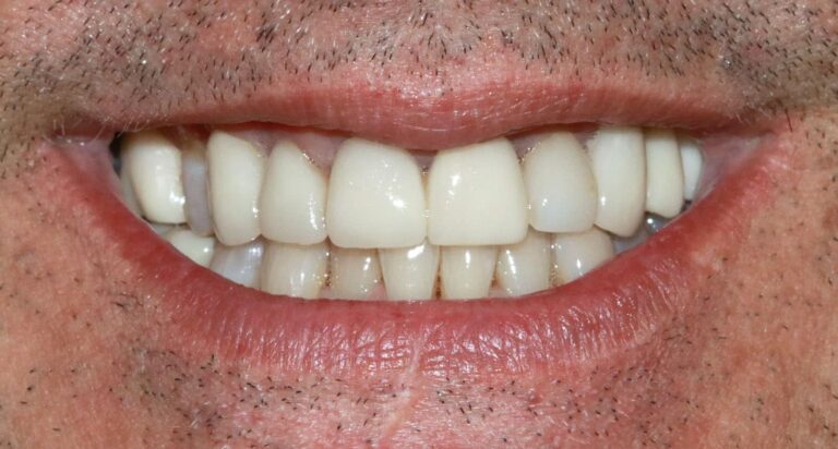 Before Image: Case 487 - front