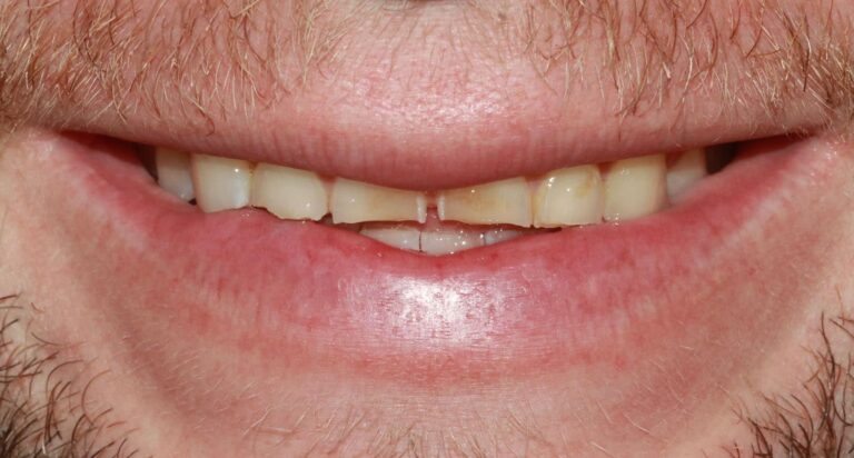Before Image: Case 488 - front