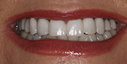 After Image: Case 49 - front