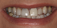 Before Image: Case 49 - front