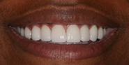 After Image: Case 50 - front