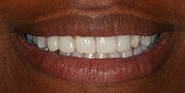 Before Image: Case 50 - front