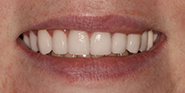 After Image: Case 51 - front