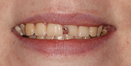 Before Image: Case 51 - front
