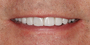 After Image: Case 52 - front