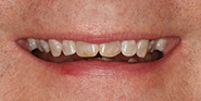 Before Image: Case 52 - front