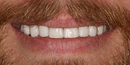 After Image: Case 54 - front