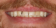 Before Image: Case 54 - front