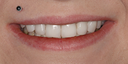 After Image: Case 55 - front
